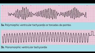 TORSADES DE POINTES 4TH YR [upl. by Vins879]