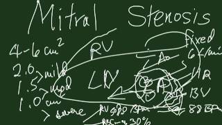 Mitral Stenosis [upl. by Barbey]