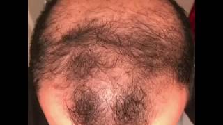 6 months using minoxidil  Rogaine 5 Before amp After results [upl. by Ellison]