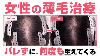 【女性の薄毛（AGA）を治す方法】何度も生えて、バレない最先端治療とは！？医師が徹底解説！（植毛・ダブルマトリックス・アートヘア）【湘南美容クリニック】 [upl. by Adnaral]