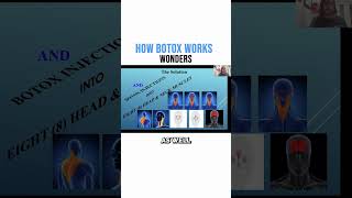 How Botox Works Wonders [upl. by Wilhelmine921]