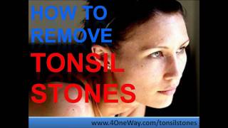 How To Remove Tonsil Stones  Tonsil Stones Treatment [upl. by Pacheco557]