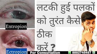 What is entropion and ectropion Dropping eyelid  Can entropion be treated without surgery [upl. by Seka]