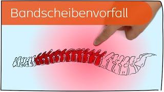 Bandscheibenvorfall in 3 Minuten erklärt [upl. by Acisse]