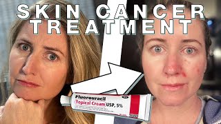 Chantelles Fluorouracil Skin Cancer Treatment  Skin Deep [upl. by Yoc]