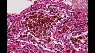 Histopathology Lung Chronic pulmonary congestion [upl. by Dominic]