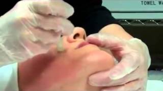 Dermapen Micro Needling Treatment [upl. by Ennayelhsa]