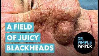 A FIELD OF JUICY BLACKHEADS [upl. by Eirojam]