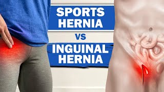 Sports Hernia Vs Inguinal Hernia  Symptoms And The Differences [upl. by Ailema]