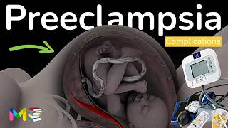 7 COMPLICATIONS OF PREECLAMPSIA Hypertension in pregnancy [upl. by Baoj]