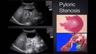 Ultrasond in Pathology  Pyloric Stenosis [upl. by Rostand815]