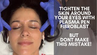 Plasma Pen Fibroblast treatment to tighten skin around my eyes The huge mistake I almost made [upl. by Annocahs]