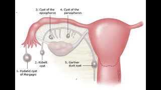 Gynecology 057 Wolffian duct remnant abnormality Gartner duct cyst Hydatid Morgagni Epoophoron [upl. by Ominoreg]