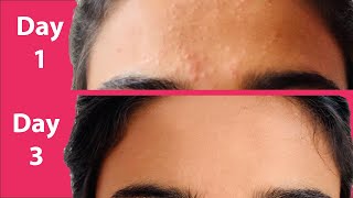 ACNE Treatment At Home  3 day Acne REMOVAL Challenge  Acne Treatment Ayurvedic with Results [upl. by Palmira654]