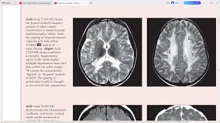 PAEDIATRIC NEURORADIOLOGY DIAGNOSTIC IMAGING [upl. by Enelahs41]