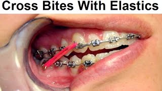 Correcting Cross Bite Using Orthodontic Elastics by Dr Mike Mew [upl. by Pallaten736]