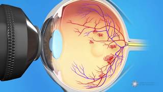 Combined Injection and Laser Treatment for Macular Edema [upl. by Ycat850]