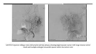 Percutaneous nBCA glue embolization of skull base tumor [upl. by Rosene748]