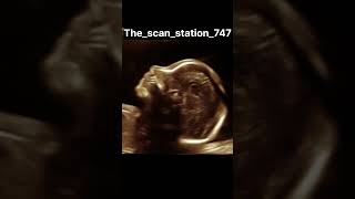 Baby abdomen baby babydoctor pregnant doctor pregnancyjourney ultrasound ultrasoundscans [upl. by Natrav]