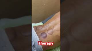 Sports Therapy  cupping therapy  middling therapy punjabisong newsong aerialyogapractice [upl. by Onateyac118]