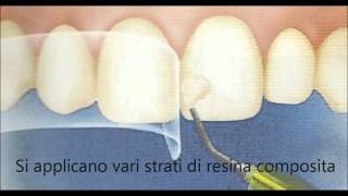 dott Montironi dentista  OTTURAZIONE ESTETICA ANTERIORE  CONSERVATIVA DENTALE [upl. by Beattie]