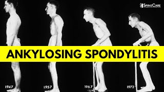 What is Ankylosing Spondylitis Causes Symptoms and Diagnosis EXPLAINED [upl. by Boony]