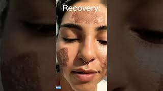 We Treated Her Acne in just One Day 😱skincare beauty shorts laser [upl. by Ketchum]