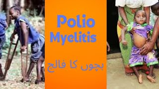 Polio myelitis [upl. by Paresh]