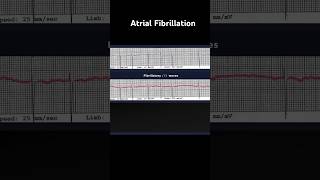 Atrial Fibrillation ECG Fibrillatory f Waves [upl. by Dabbs]