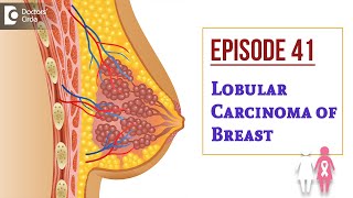 Lobular Carcinoma Of Breast  Milk producing gland CancerDrSandeep NayakSamrohanaDoctors Circle [upl. by Nezah801]