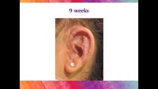 Microtia Ear Surgery  The Healing Process with the Porous Implant Ear Reconstruction technique [upl. by Neelhtakyram]