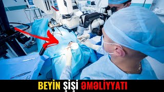 Beyin şişi əməliyyatı Təhlükəlidir [upl. by Temme]