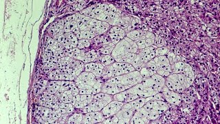 What is Hyperplasia  Pathology mini tutorial [upl. by Cr]