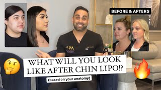 How Youll Look After Chin Lipo Before and After [upl. by Eirised]