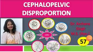 57 Cephalopelvic Disproportion [upl. by Neeka]