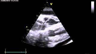 CARDIAC PERFORATION  postimplantation pericardial effusion [upl. by Jimmy987]