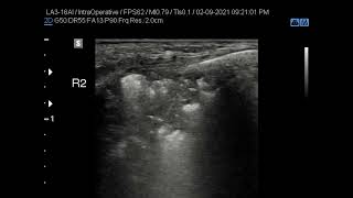 10  Pneumonia Dynamic fluid bronchogram [upl. by Rusert]