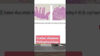 Coeliac diseaese pathophysiology شرح بالعربي [upl. by Sand484]