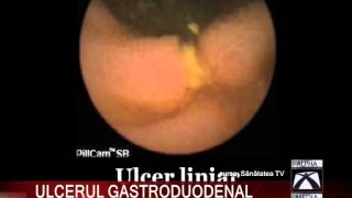 ULCERUL GASTRODUODENAL [upl. by Dimitri]