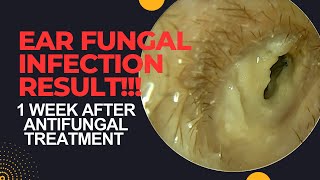 RESULT Of Antifungal Treatment In Otomycosis After 1 WEEK [upl. by Notnilk571]