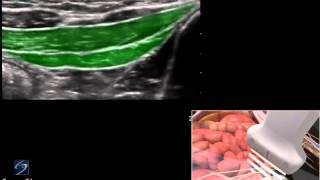 3D How To Ultrasound Guided Ilioinguinal and Iliohypogastric Nerve Block  SonoSite Ultrasound [upl. by Claudianus]