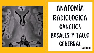 Anatomía Radiológica Ganglios basales y tallo cerebral [upl. by Lael]