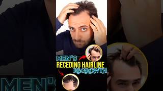 Receding Hairline regrowth derma roller hair mensgrooming [upl. by Ogren937]