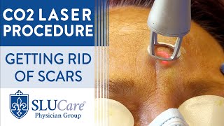 CO2 Laser Resurfacing Treatment For Getting Rid of Scars  Full Procedure [upl. by Narba]