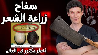 أخطر دكتور زراعة شعر في العالم و نتايجه رهيبة جدا I برنامج البسيط [upl. by Elamaj269]