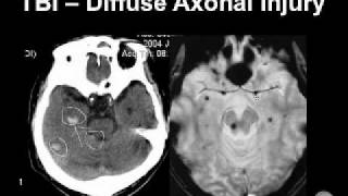 Diagnosing Brain Hemorrhages [upl. by Kreindler]