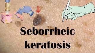 Seborrheic Keratosis Dermatitis Age Spots  Causes Signs amp Symptoms amp Treatment [upl. by Manas]