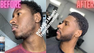 Minoxidil Beard Journey  35 Month Transformation insane minoxidil update [upl. by Suaeddaht]