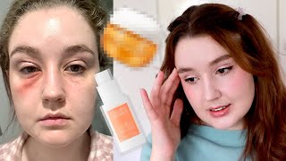 im allergic to my skincare im a dumb baby storytime [upl. by Em99]