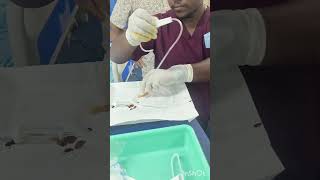 Asciticfluid tappingparacentesis medicostappingprocédure medicalstudentviralvideo paramedical [upl. by Arres]